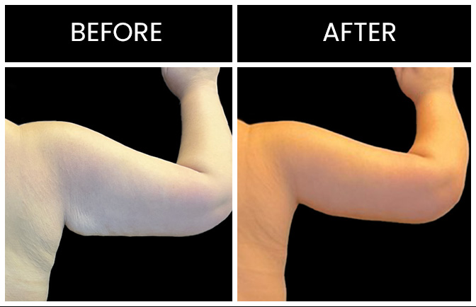 Atlanta Arm Lift Results